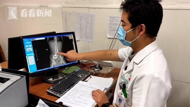 视频｜9岁男孩接连吞下74颗磁力珠 致80厘米小肠切除