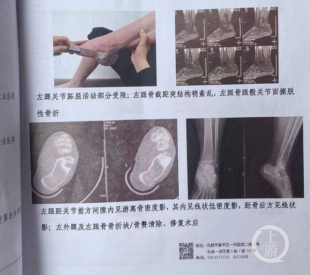 ▲李雪的伤残鉴定报告显示，其存在活动受限情况。摄影/上游新闻记者胡磊