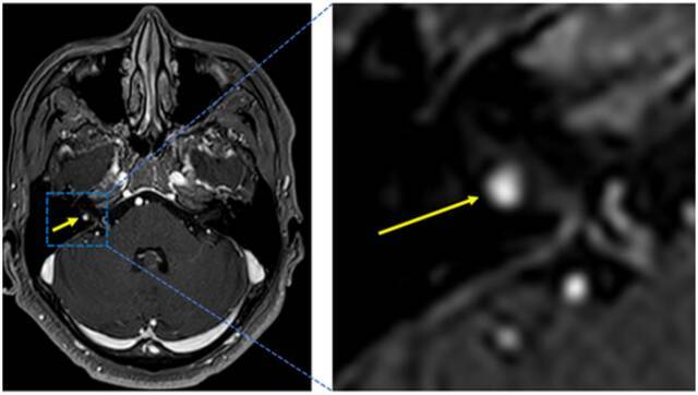 术前颅脑MRI（黄色箭头显示为听神经瘤）。通讯员供图