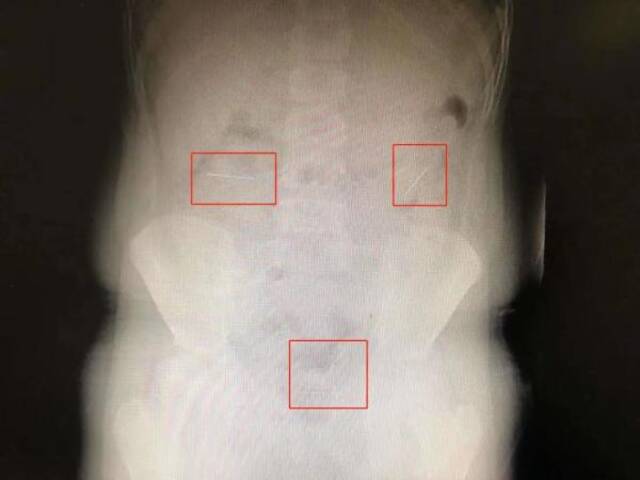 为向同学“证明”自己是魔术师，10岁男孩连吞四枚定位针
