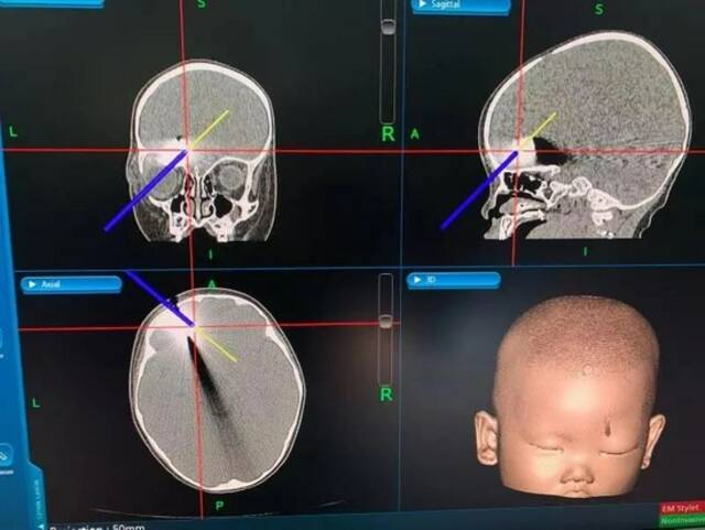家长最担心的事情再次发生：利刃紧贴眼球扎进1岁女婴颅内！