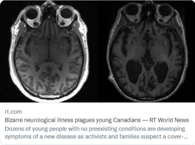 在加拿大新不伦瑞克省，部分不明神经系统疾病的患者出现认知能力下降、脑萎缩等症状。/社交媒体截图