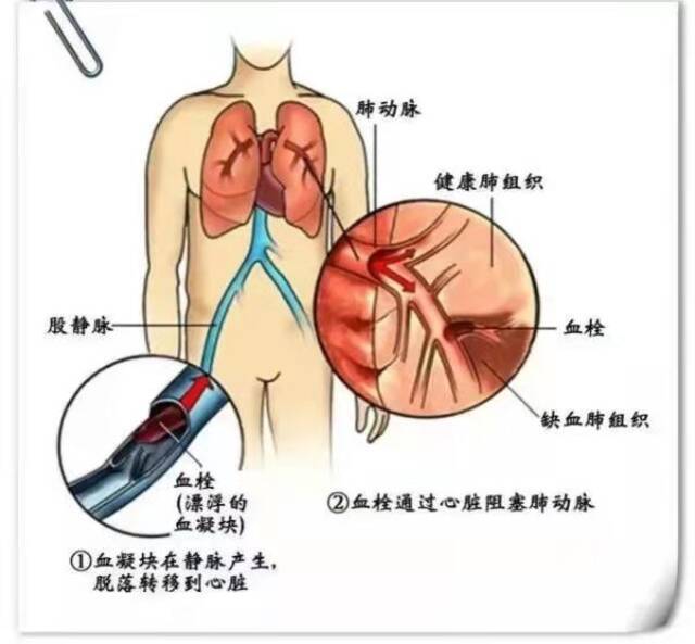 网约车司机每天接单15小时，久坐引起肺栓塞进ICU