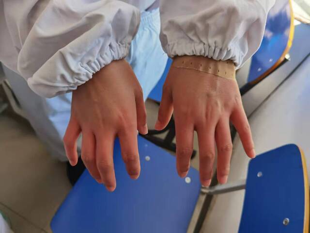 工作中护士的手被冻伤