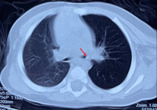 经CT检查为支气管异物。本文图片均为受访者提供