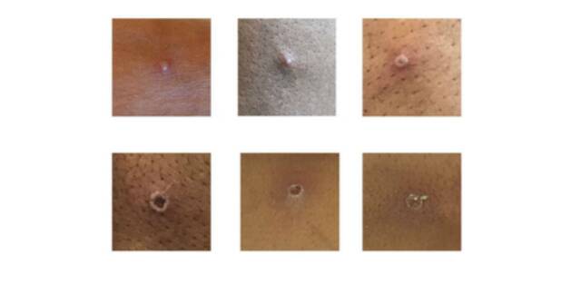 图为猴痘患者皮肤表面出现的症状图片来源：英国卫生安全局