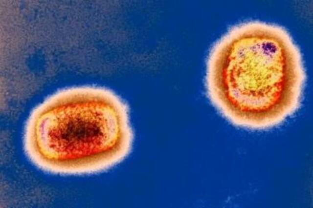 彩色透射电子显微捕获的猴痘病毒颗粒。英国《新科学家》杂志网站图