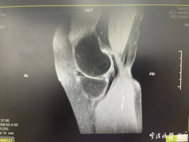 患者右膝半月板因为高强度跳绳而损伤