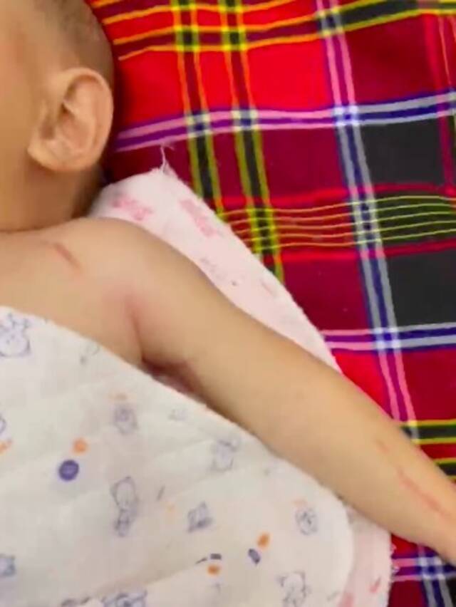 郭女士称，宝宝右手处于瘫痪状态。受访者供图