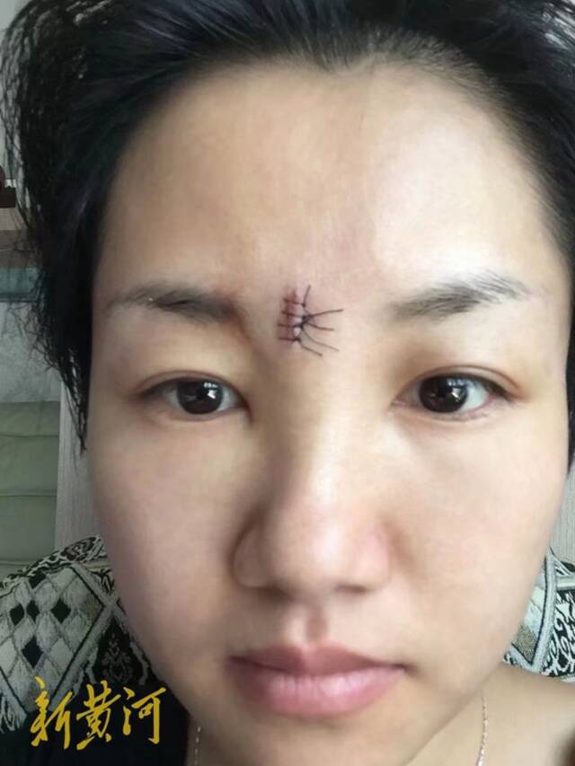 唐萍被家暴后面部受伤缝针
