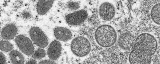 电子显微镜下的猴痘病毒。（资料图）