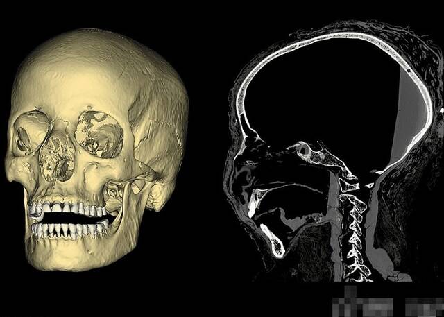 全球唯一怀有胎儿的古埃及木乃伊“神秘女士”或死于鼻咽癌