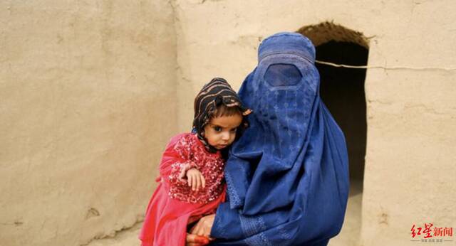 ↑阿富汗儿童严重营养不良