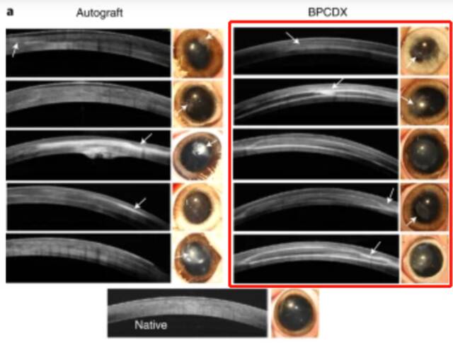 图|BPCDX植入6个月后效果