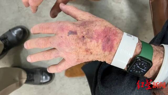 ↑保罗的手部当时因撞车出现淤伤