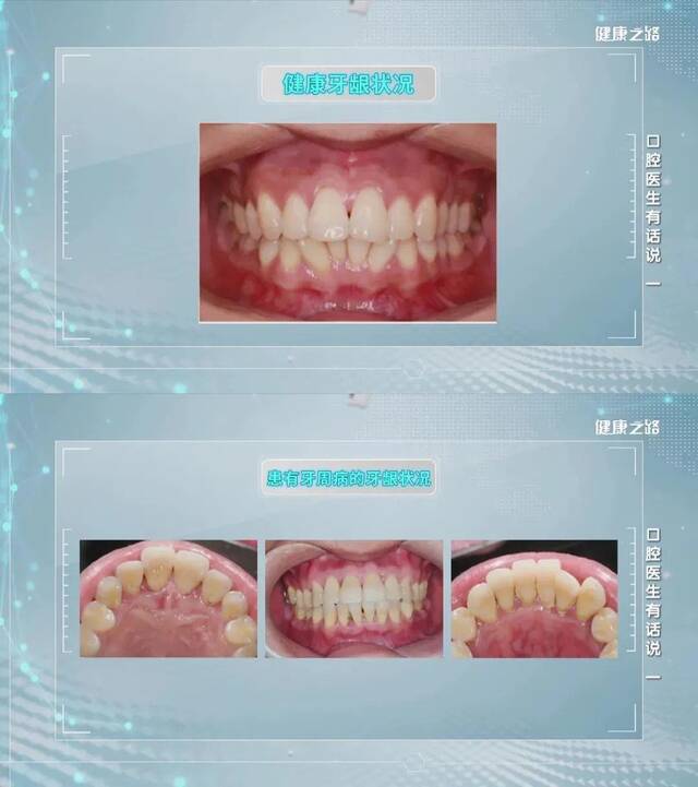 牙齿松动、敏感、牙龈出血……这可能是牙周病，不能拖！