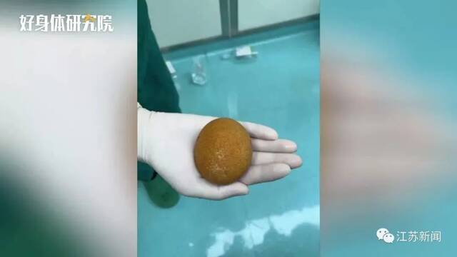 重100克！男子排尿疼痛，医生取出结石大如鹅蛋，几乎占满膀胱……