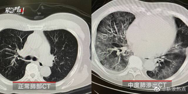 前央视主持人父亲“白肺”去世：为什么有些人看起来没症状，但突然就不行了？