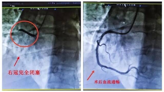 阳后一个月，此项风险增加33倍！