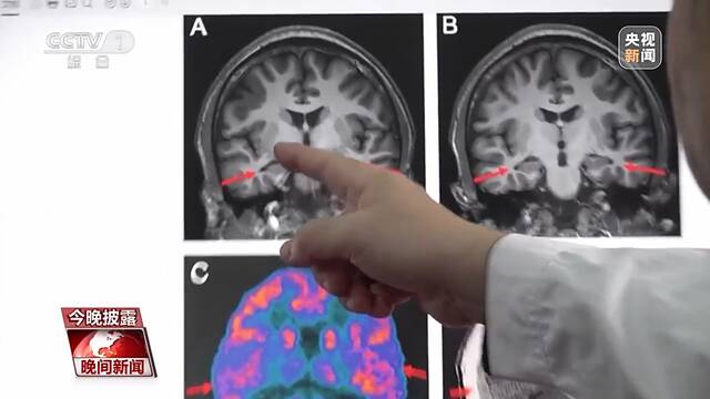 丢失的记忆丨阿尔茨海默病不是老年人“专利”