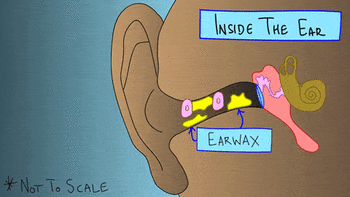 长期“掏耳朵”导致患癌，这个习惯你可能也有