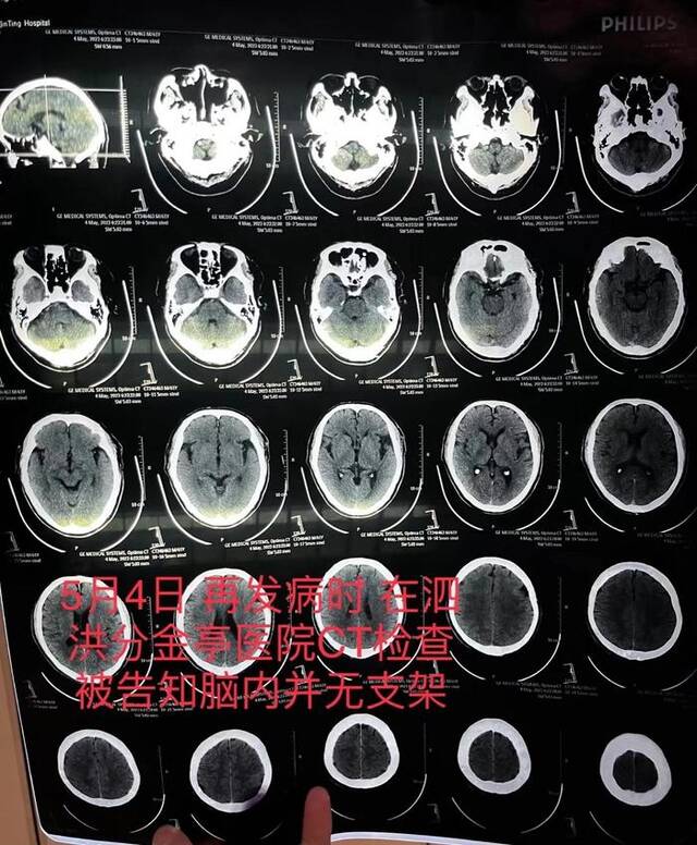 朱老汉在泗洪县分金亭医院的CT检查报告，显示颅内并无支架。朱先生供图