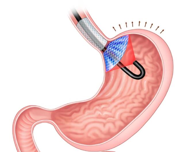 如图所示，图中蓝色和灰色部分是“胃内饱腹诱导装置(ISD)”植入物，它通过按压胃部产生饱腹感，当该植入物涂层被激光激活时，就会杀死产生饥饿激素的细胞。