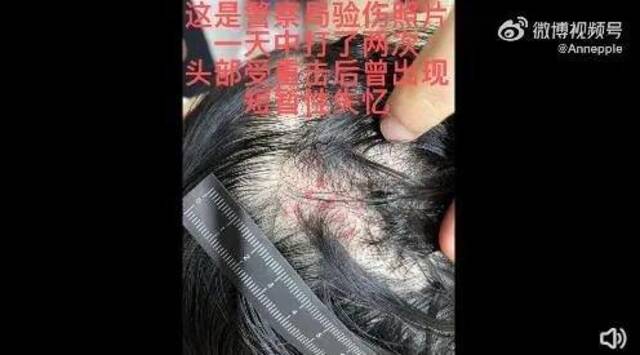 演员夫妇和好，女方曾称被丈夫拳打脚踢，头部受重伤，被公公开车撞！