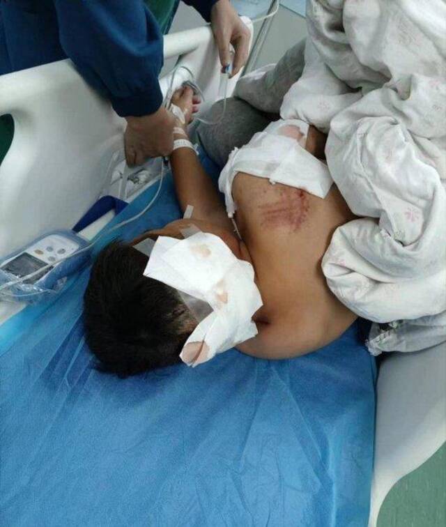 湖南省邵阳市城步县丹口镇10岁男童轩轩被狗咬伤后，在ICU病房内抢救。受访者供图