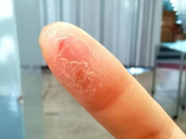 图说：记者在瑞幸咖啡工作期间，右手食指“烂手”最严重时。图源：记者