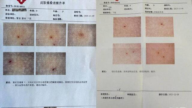 内蒙古一幼儿园女童身上现12个针眼，系“牙签”所扎？