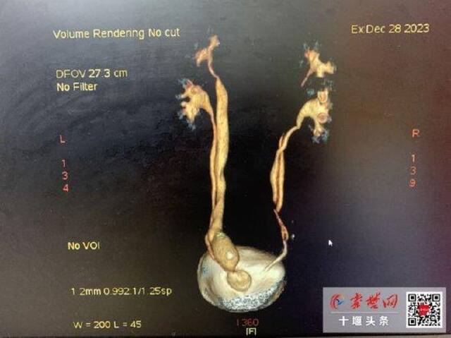 襄阳6岁女孩竟长4个肾，太和专家成功为其保留所有肾