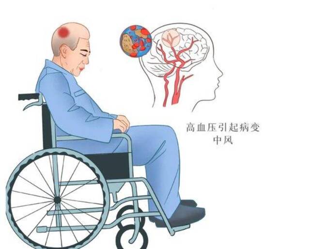 脑梗死患者如需接受高压氧治疗，需要注意什么？