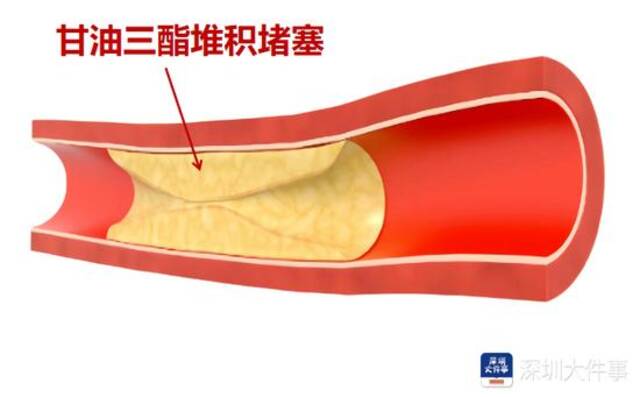 吓人！深圳一女子体内抽出“牛奶血”，有这些习惯的人要注意