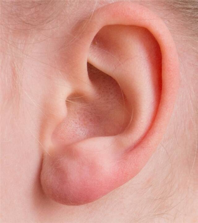 耳朵总是痒 却啥也掏不出来！可能暗示这5种问题