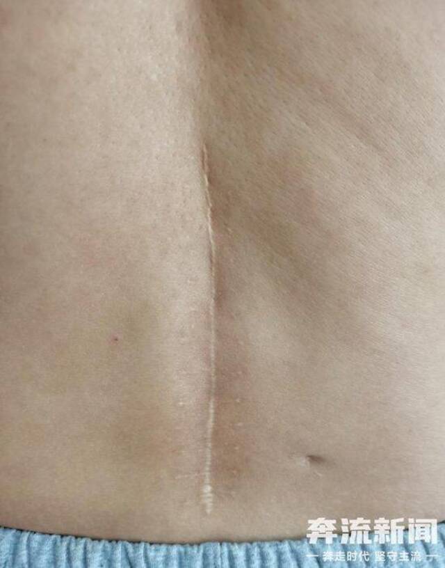 如今11年过去，杨银宝后腰部的伤疤清晰可见。