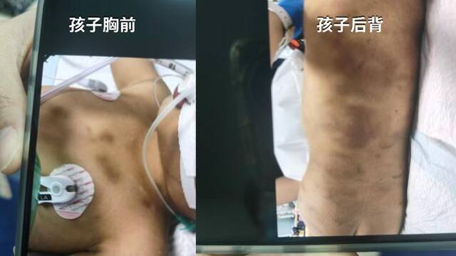 离开生母7个月，3岁男童被生父女友虐待致死